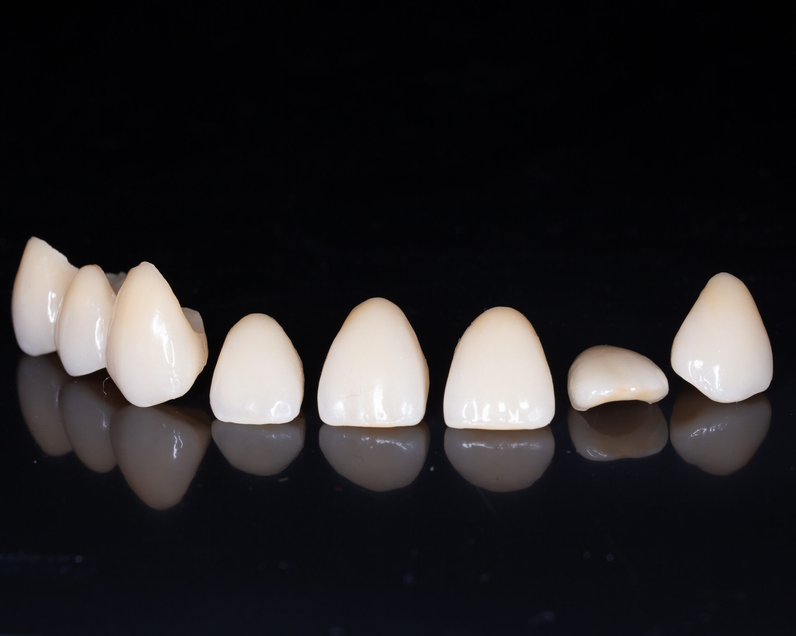Veneers