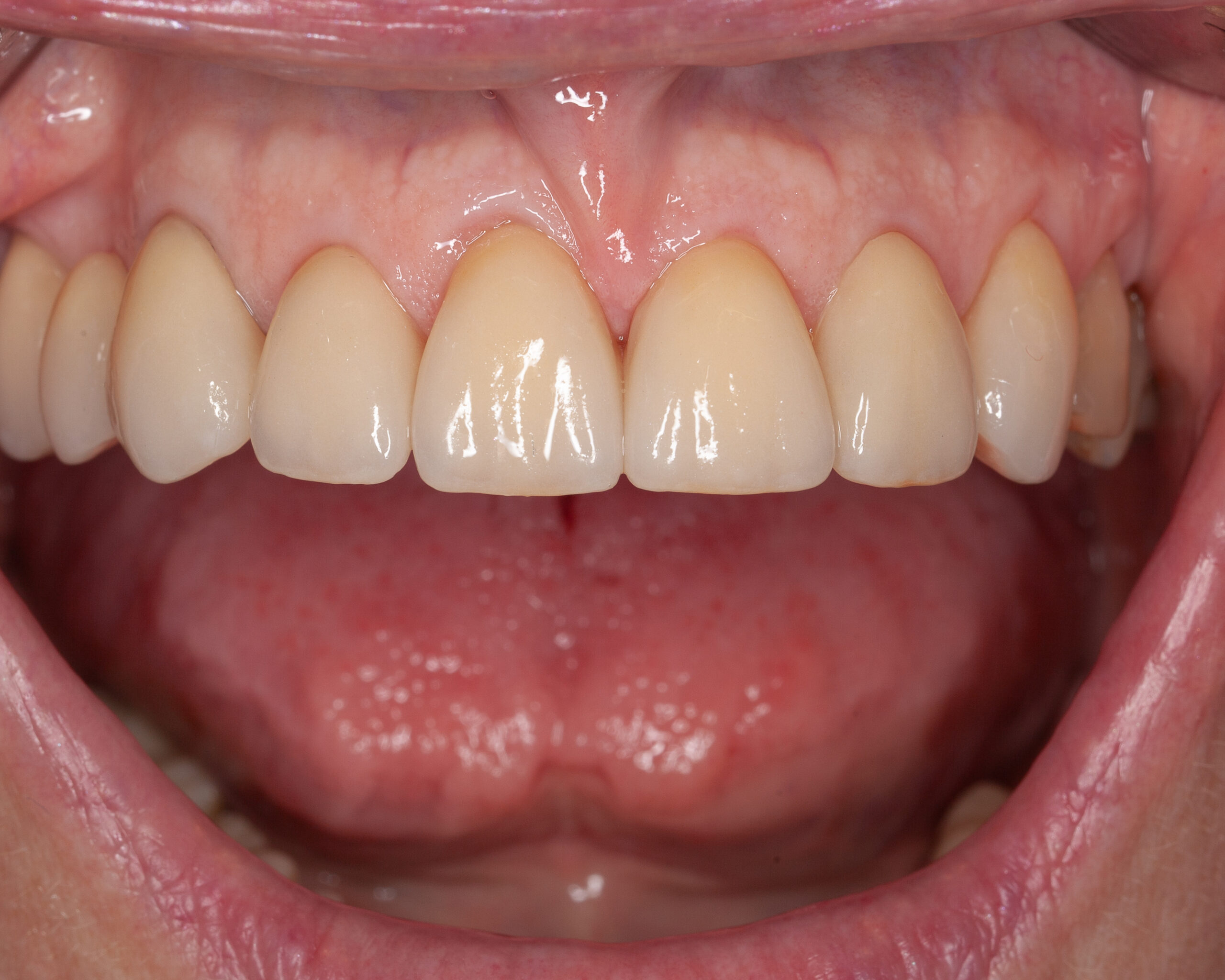 veneers nachher