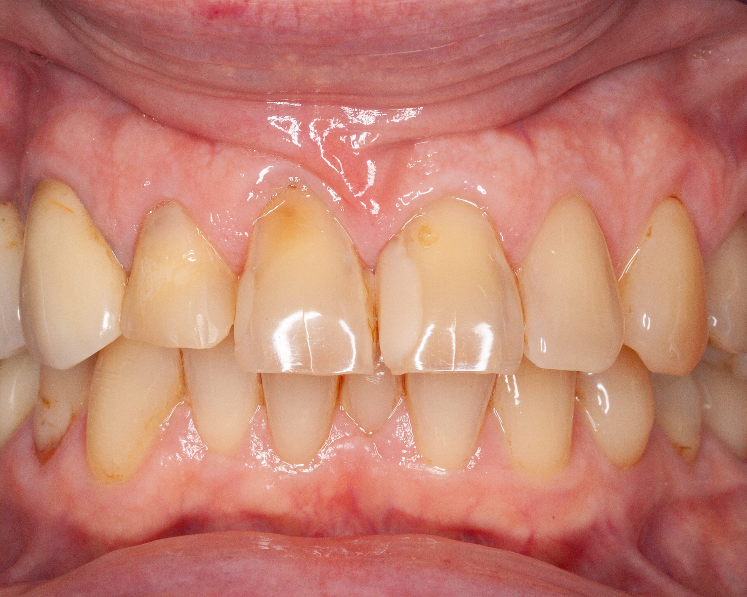 veneers vorher